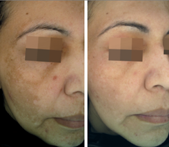 Cosmelan Treatment